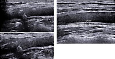 Novel Surrogate Markers of Cardiovascular Risk in the Setting of Autoimmune Rheumatic Diseases: Current Data and Implications for the Future